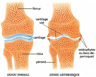 L'arthrose du dos