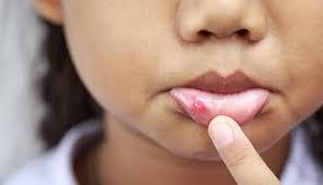 Herpes labial