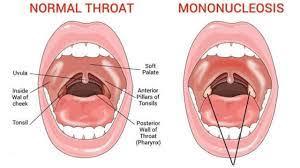 Mononucleose 2