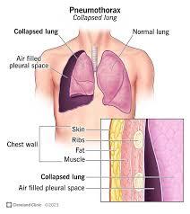 Pneumothorax1