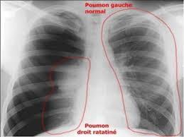 Pneumothorax2