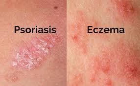 Psoriasis2