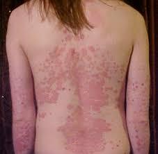 Psoriasis3